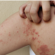 impetigen