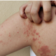 impetigen