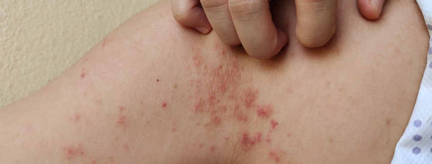 impetigen
