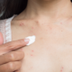 dermatitis atòpica