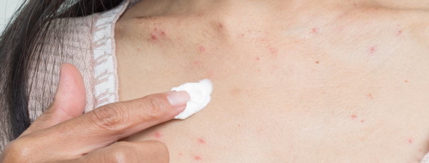 dermatitis atòpica